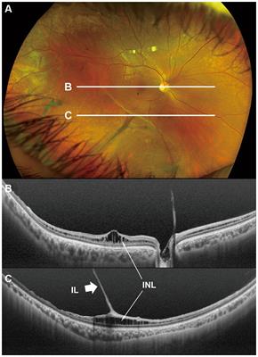 Optical coherence tomography findings of the peripheral retina in patients with congenital X-linked <mark class="highlighted">retinoschisis</mark>